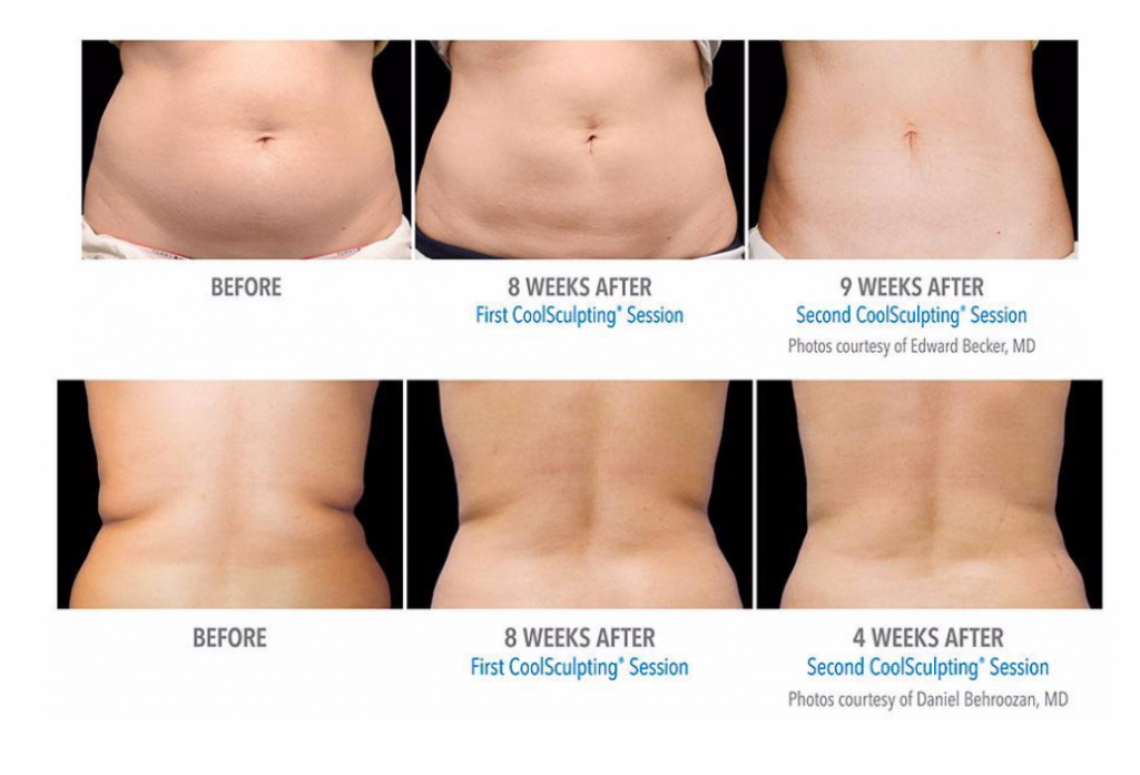 CoolSculpting in Vancouver