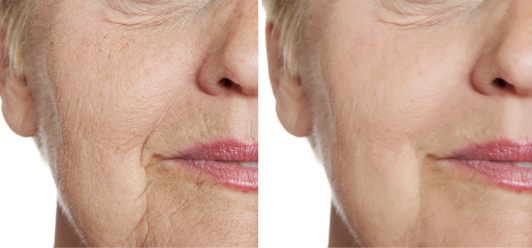 Morpheus8: Combining the Benefits of Microneedling and Radiofrequency