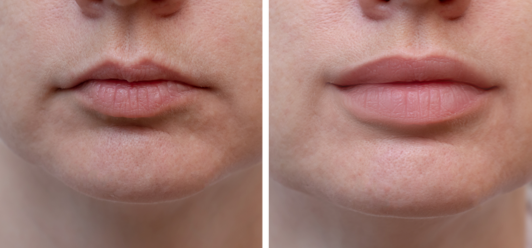Tips to Prolong the Effects of Dermal Fillers