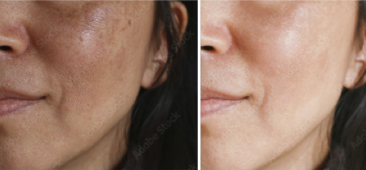 Reverse the Appearance of Sun Damage with Lumecca IPL in Vancouver