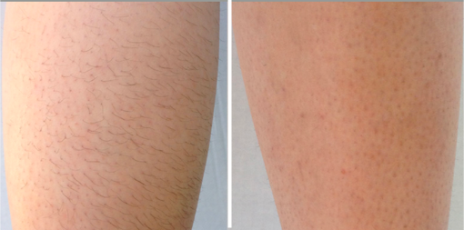 Go Hair-Free for the Holidays – Laser Hair Removal in Vancouver